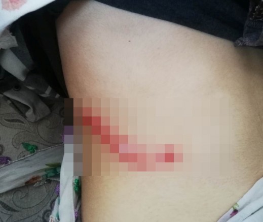 14 yaşında ki çocuk sokak köpeklerinin saldırısına uğradı