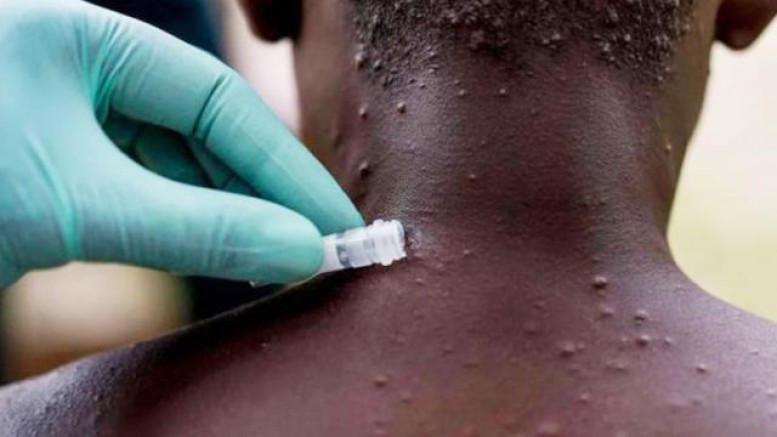 Avusturya'da maymun çiçeği virüsüne bağlı yeni vakalar tespit edildi