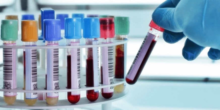 Çinli bilim insanları, akciğer kanserini önceden tespit edebilen kan testi geliştirdi