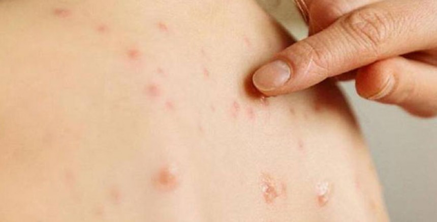 Avusturya'da Kızamık Vakaları Artıyor: Tirol'de Altı Yeni Vaka Tespit Edildi!