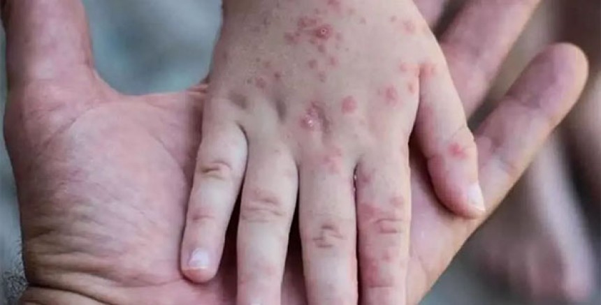  Niederösterreich Eyaletinde Kızamık Vakalarında Hızlı Artış